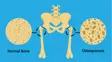 Normal and osteoporotic bone image differentiated clearly